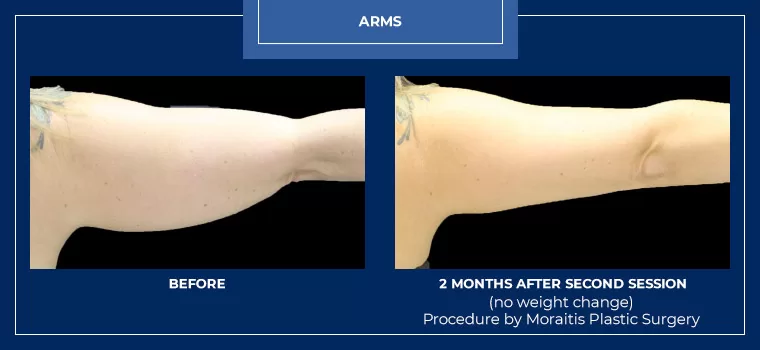 Moraitis palm harbor coolsculpting patient 17 1