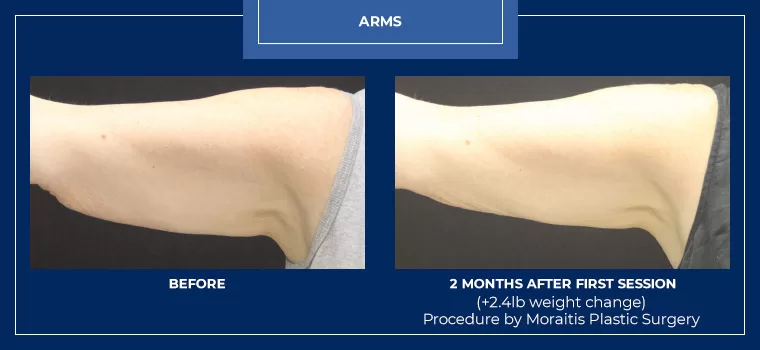 Moraitis palm harbor coolsculpting patient 18 1
