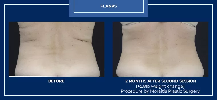 Moraitis palm harbor coolsculpting patient 19 1