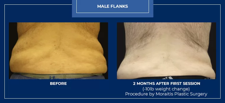 Moraitis palm harbor coolsculpting patient 20 1