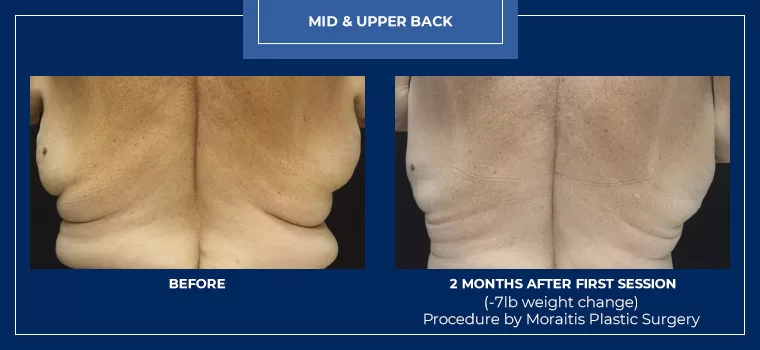 Moraitis palm harbor coolsculpting patient 21 1
