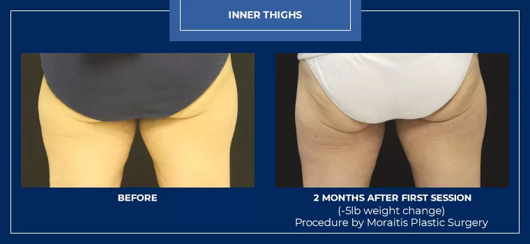Moraitis palm harbor coolsculpting patient 5 1
