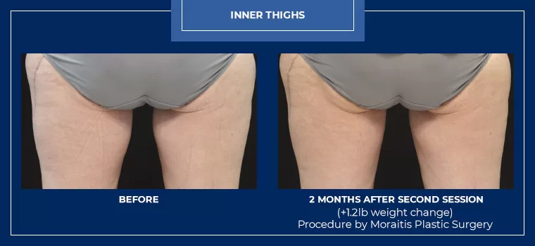 Moraitis palm harbor coolsculpting patient 6 1