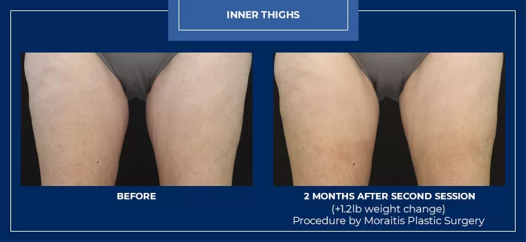 Moraitis palm harbor coolsculpting patient 6 2