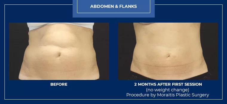 Moraitis palm harbor coolsculpting patient 7 1