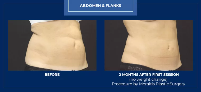 Moraitis palm harbor coolsculpting patient 7 2