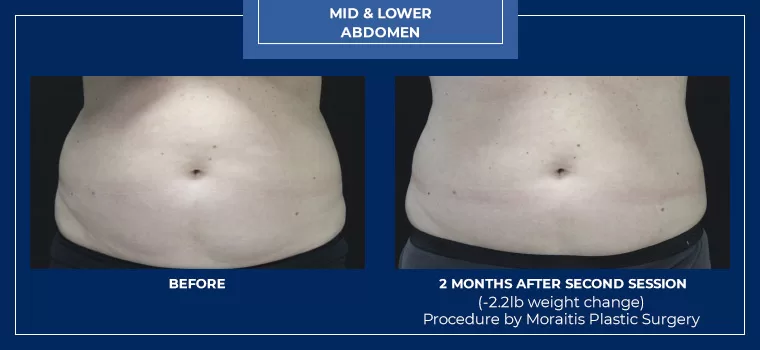 Moraitis palm harbor coolsculpting patient 8 1