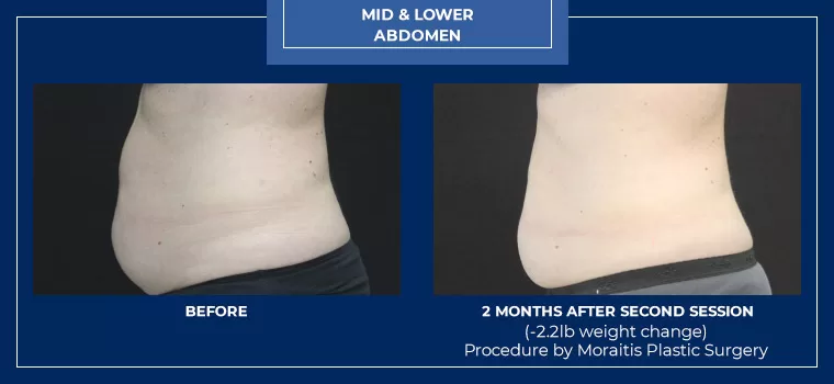 Moraitis palm harbor coolsculpting patient 8 2
