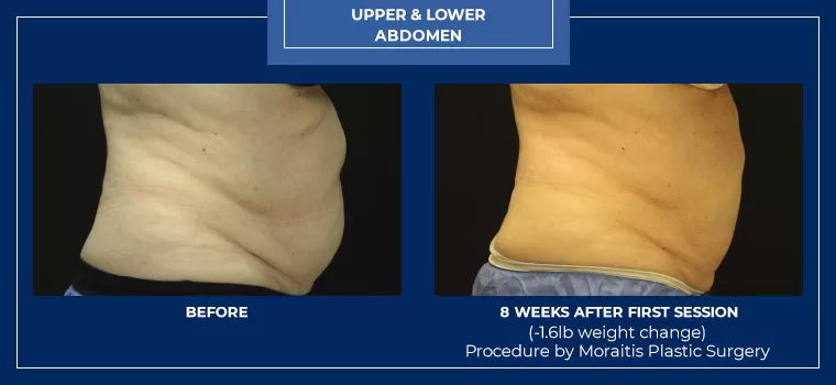 Moraitis palm harbor coolsculpting patient 9 1