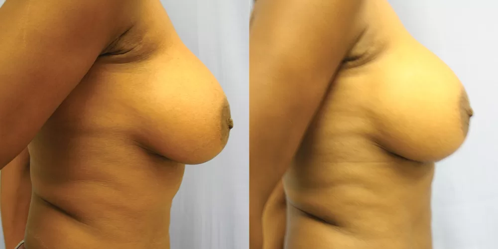 Breast implant exchange 0000 moratis plastic surgery breast implant exchange patient 1a