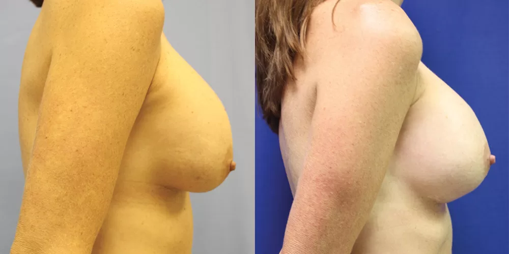 Breast implant exchange 0003 moratis plastic surgery breast implant exchange patient 2a