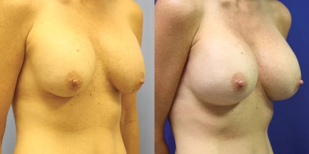 Breast implant exchange 0004 moratis plastic surgery breast implant exchange patient 2b
