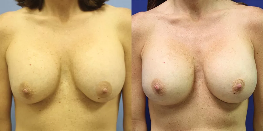 Breast implant exchange 0005 moratis plastic surgery breast implant exchange patient 2c