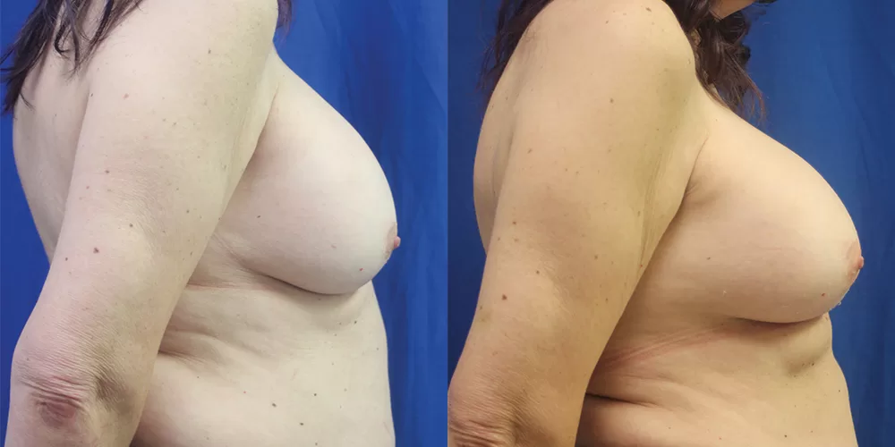 Breast implant exchange 0006 moratis plastic surgery breast implant exchange patient 3a