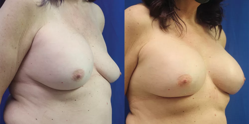 Breast implant exchange 0007 moratis plastic surgery breast implant exchange patient 3b