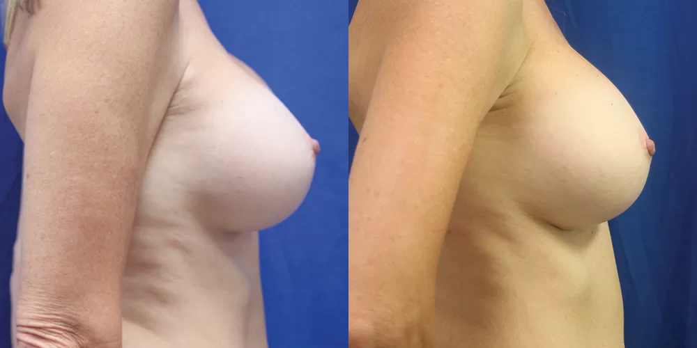 Breast implant exchange 0009 moratis plastic surgery breast implant exchange patient 4a