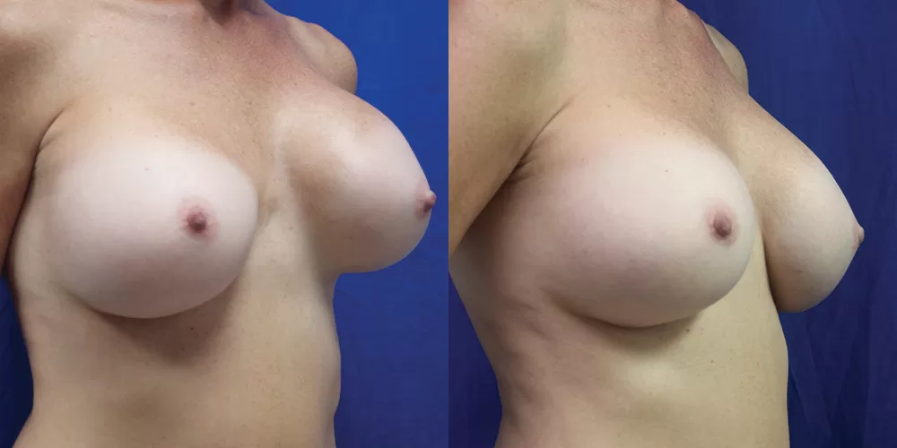 Breast implant exchange 0010 moratis plastic surgery breast implant exchange patient 4b