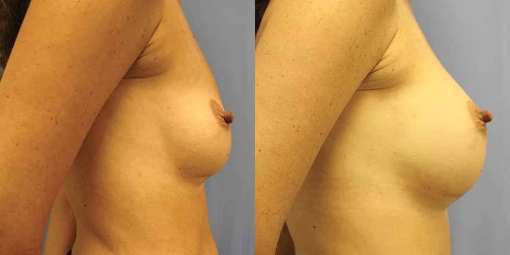 Breast implant exchange 0015 moratis plastic surgery breast implant exchange patient 6a