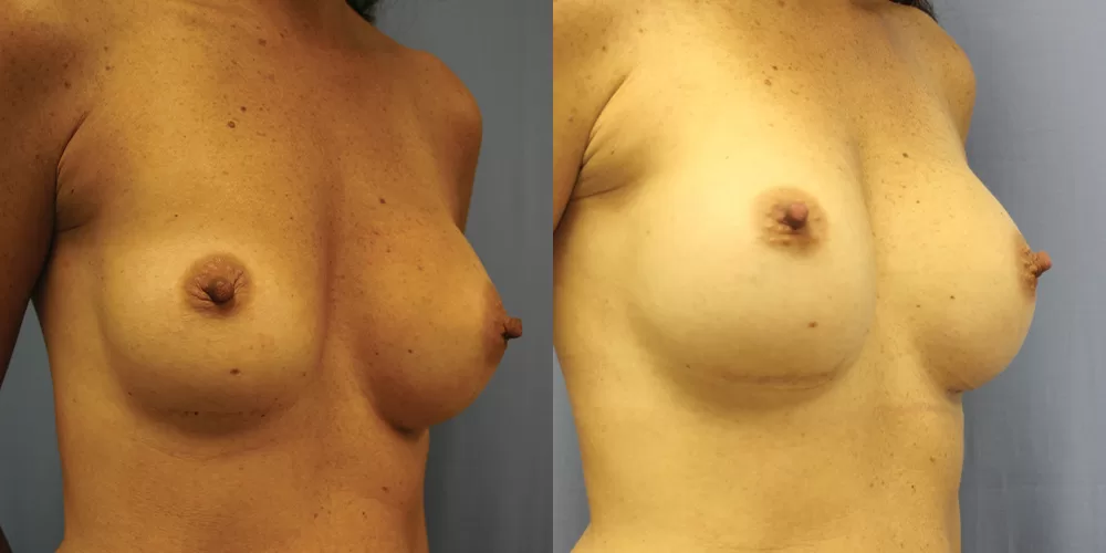 Breast implant exchange 0016 moratis plastic surgery breast implant exchange patient 6b