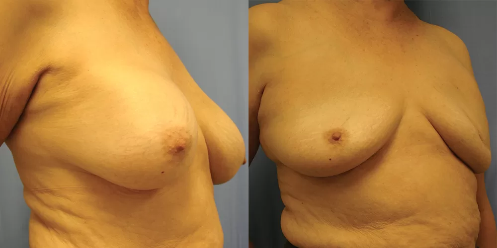Breast implant removal 0001 moratis plastic surgery breast implant removal patient 1b