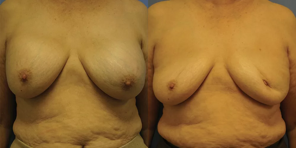 Breast implant removal 0002 moratis plastic surgery breast implant removal patient 1c