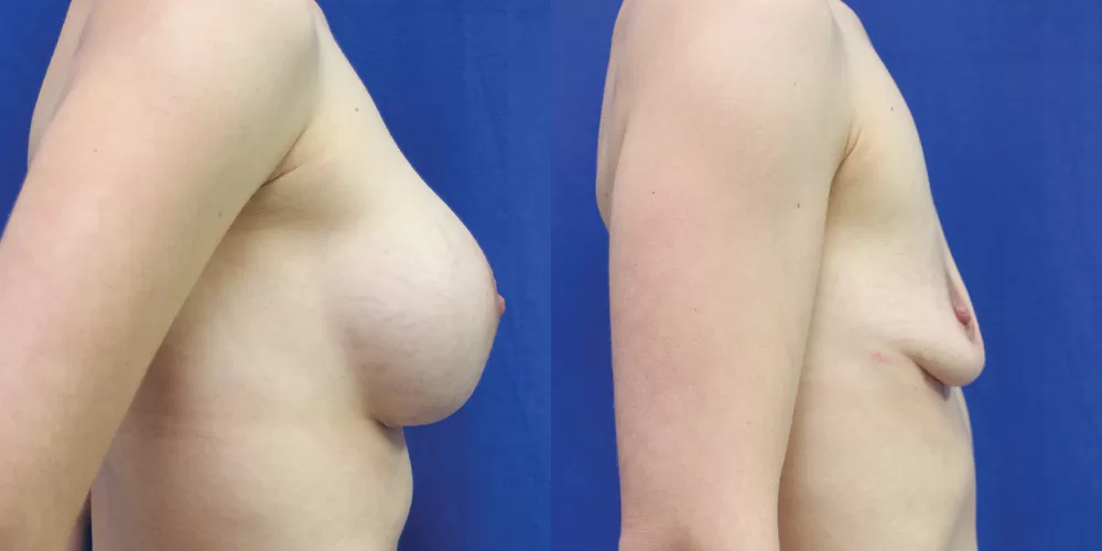 Breast implant removal 0003 moratis plastic surgery breast implant removal patient 2a