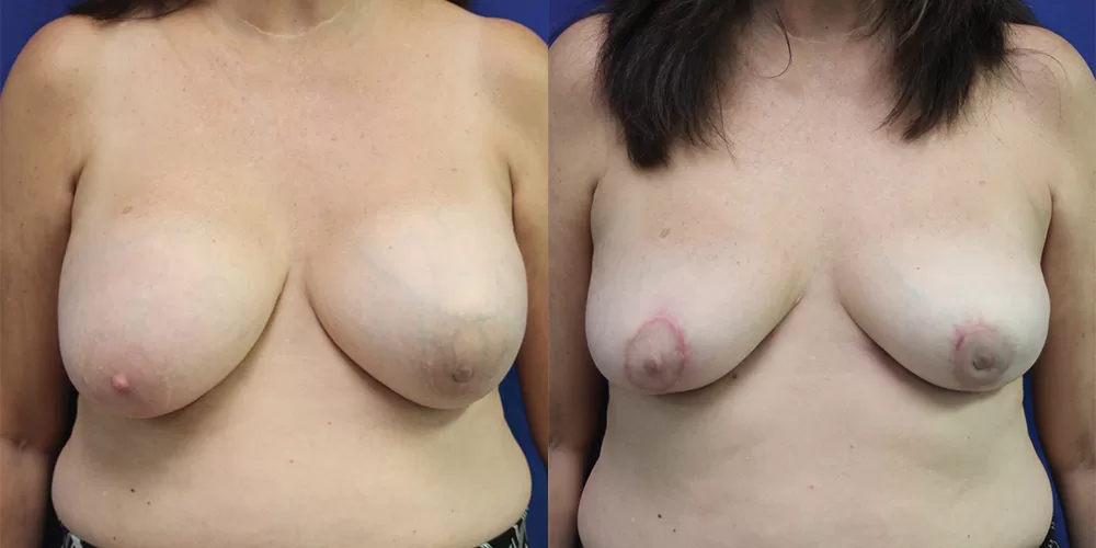 Moratis plastic surgery breast implant removallift patient 1a