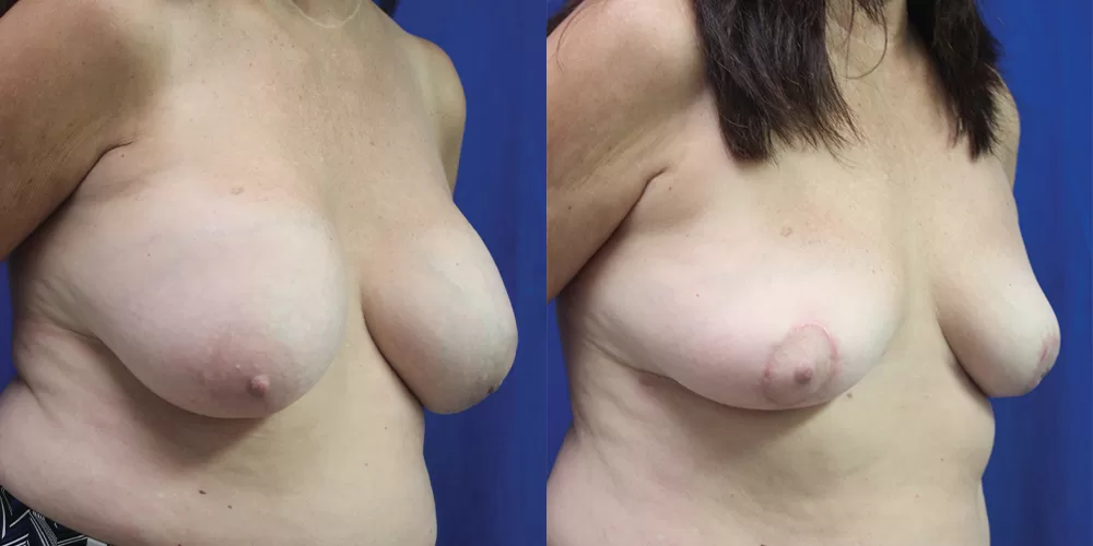 Moratis plastic surgery breast implant removallift patient 1b