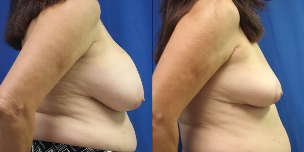 Moratis plastic surgery breast implant removallift patient 1c