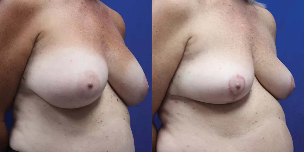 Moratis plastic surgery breast implant removallift patient 2b