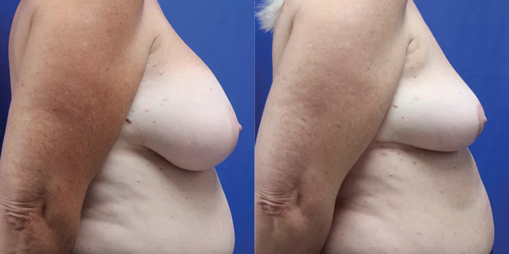 Moratis plastic surgery breast implant removallift patient 2c