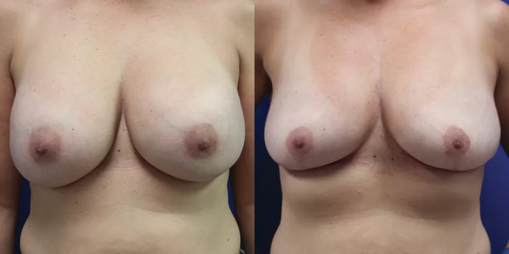 Moratis plastic surgery breast implant removallift patient 3a