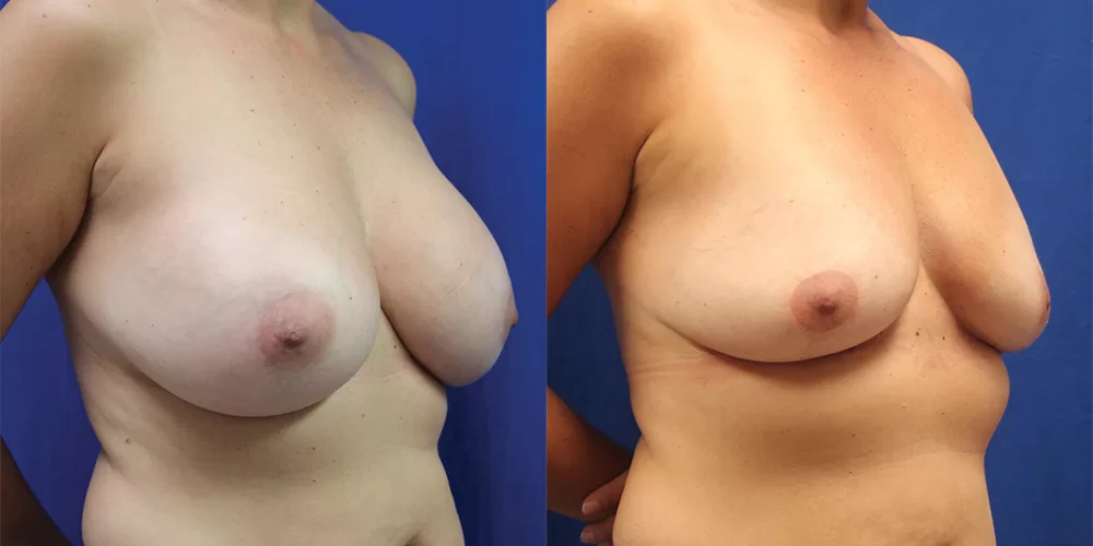 Moratis plastic surgery breast implant removallift patient 3b