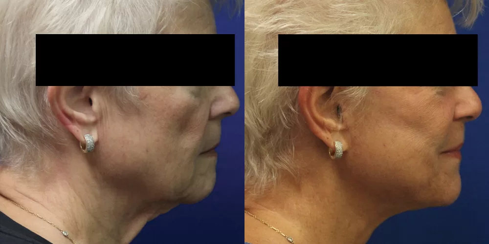 Moratis plastic surgery face lift patient 1a