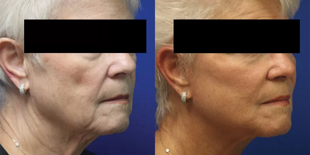 Moratis plastic surgery face lift patient 1b