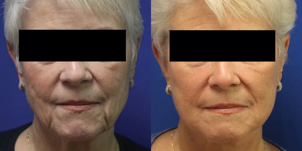 Moratis plastic surgery face lift patient 1c