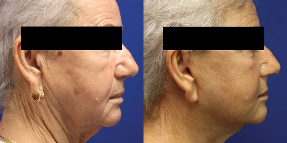 Moratis plastic surgery face lift patient 2a