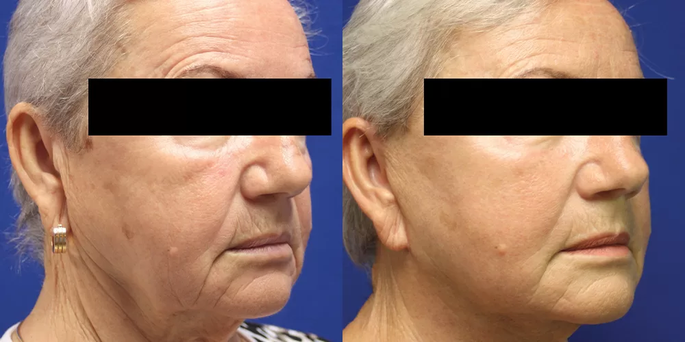 Moratis plastic surgery face lift patient 2b
