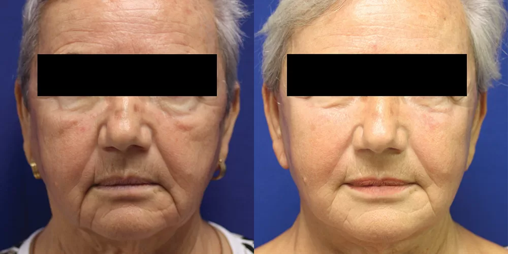 Moratis plastic surgery face lift patient 2c