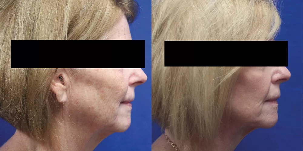 Moratis plastic surgery face lift patient 3a