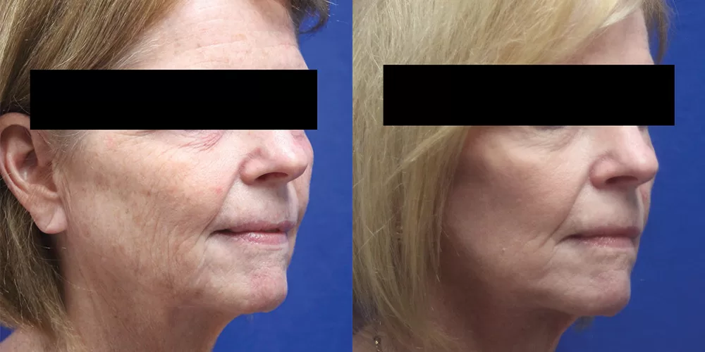 Moratis plastic surgery face lift patient 3b