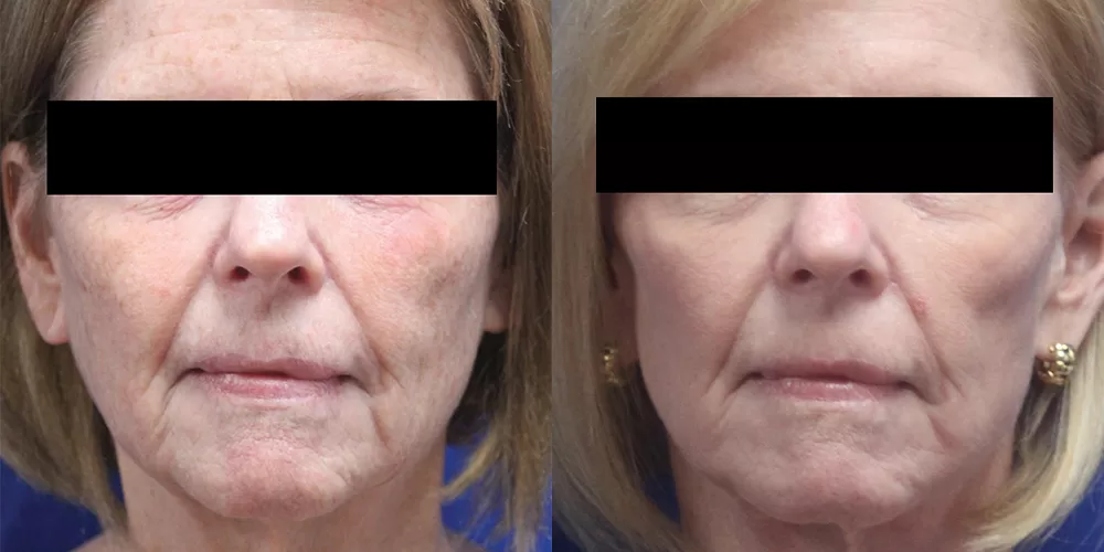 Moratis plastic surgery face lift patient 3c