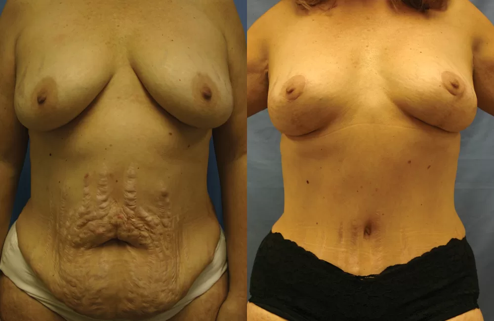 Moratis plastic surgery mommy makeover patient 1a