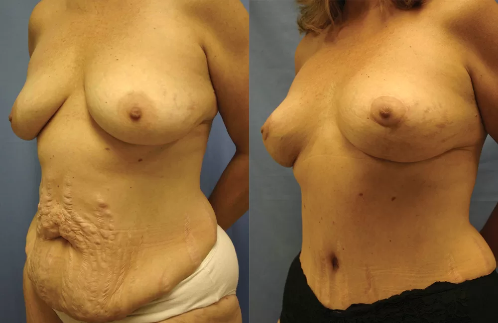 Moratis plastic surgery mommy makeover patient 1b