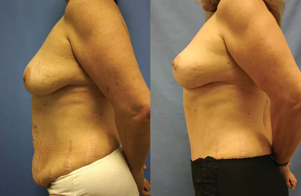Moratis plastic surgery mommy makeover patient 1c