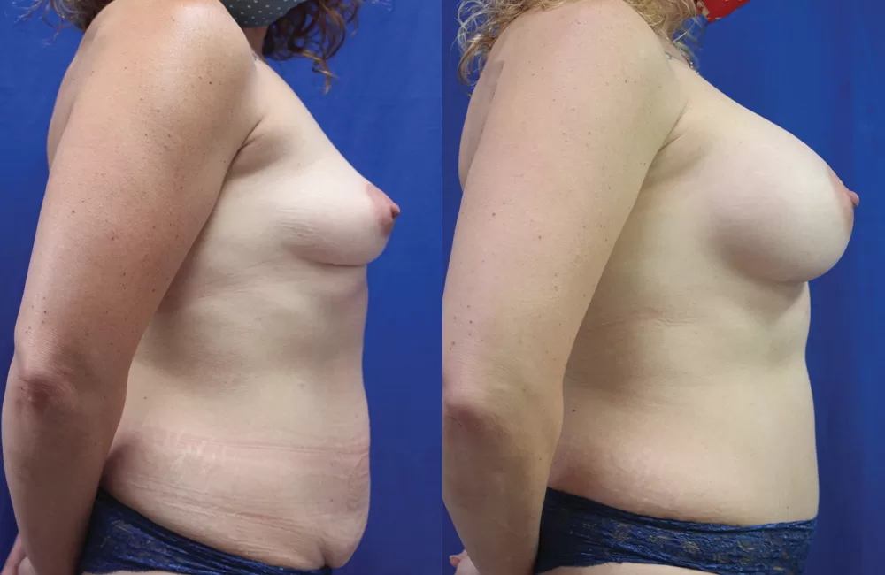 Moratis plastic surgery mommy makeover patient 2a