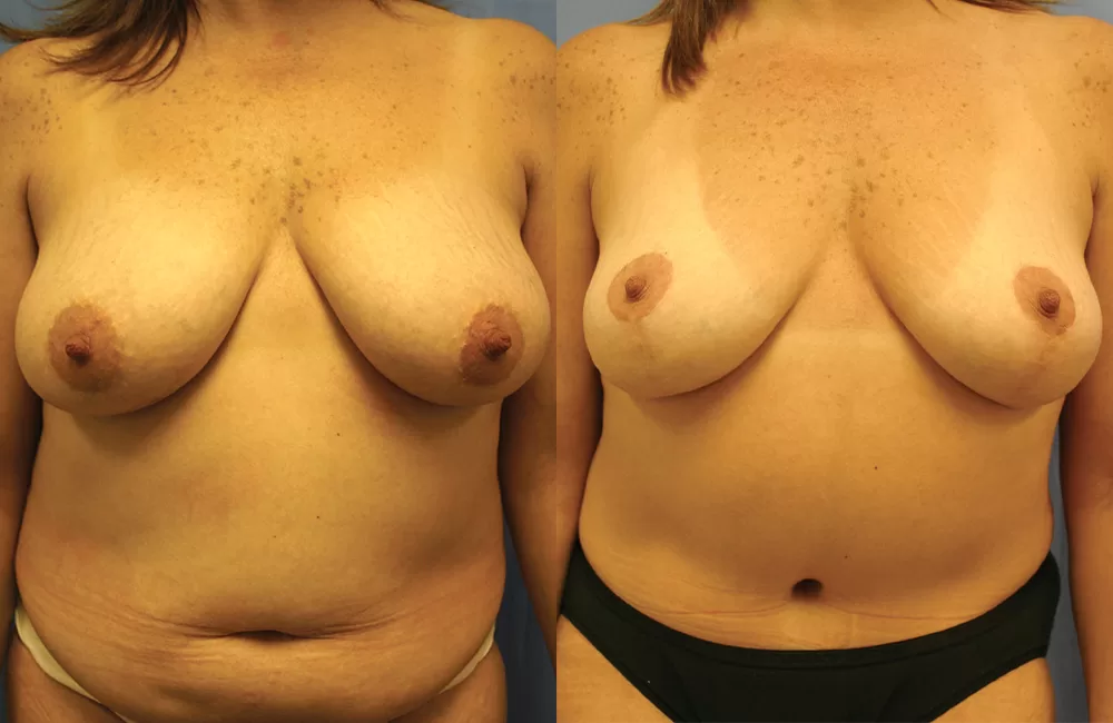 Moratis plastic surgery mommy makeover patient 3a