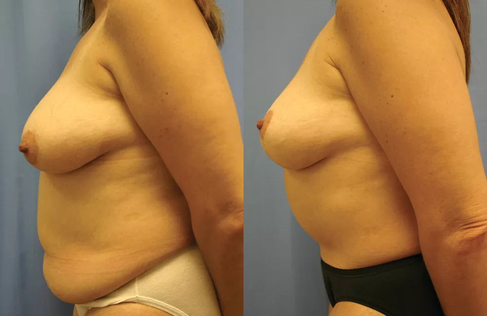 Moratis plastic surgery mommy makeover patient 3b