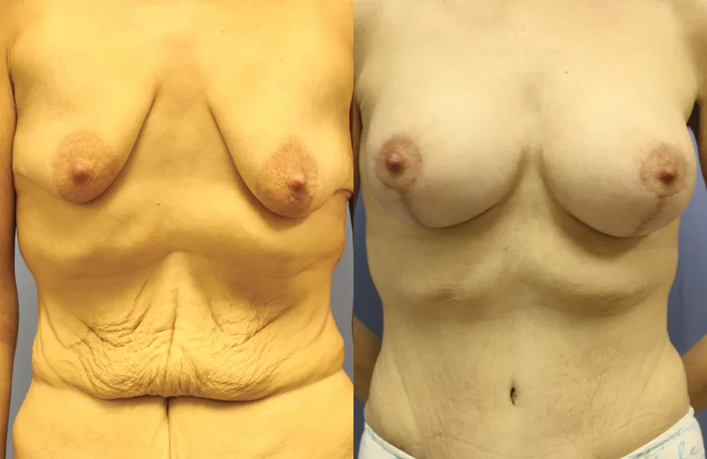 Moratis plastic surgery mommy makeover patient 4a
