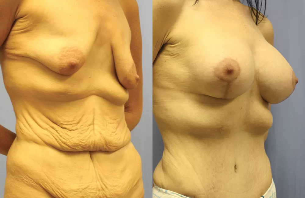 Moratis plastic surgery mommy makeover patient 4b